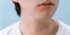 A close-up image of a person's lips showing a cold sore on the lower lip area.